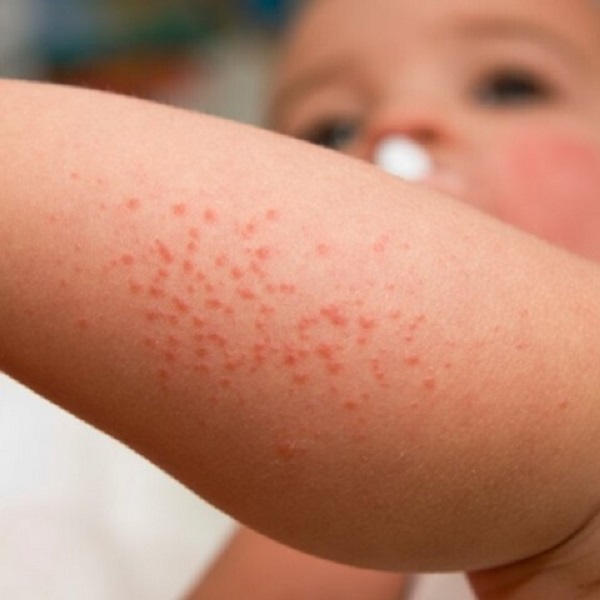 baby eczema